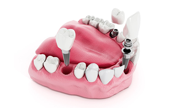 Chirurgia implantare