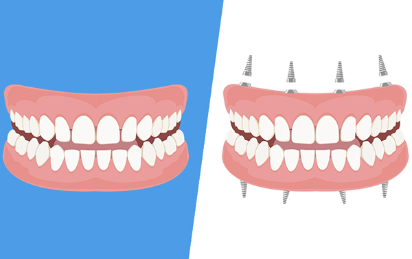 Dentiera o impianto fisso?