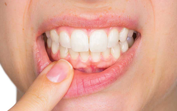 Impianti dentali in titanio e allergia al nichel