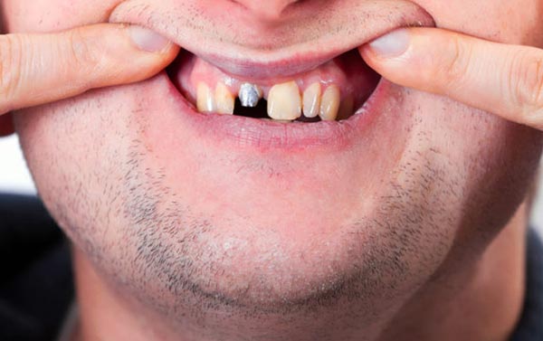 Perché alcuni impianti dentali falliscono