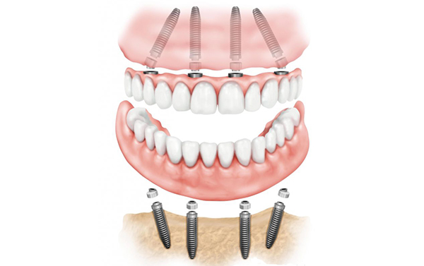 Impianti dentali senza osso: zigomatici e all on four