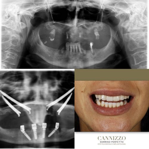 Caso impianti zigomatici