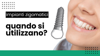 Impianti zigomatici, quando si utilizzano