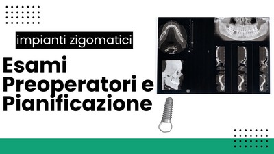 Impianti zigomatici, esami preparatori e pianificazione