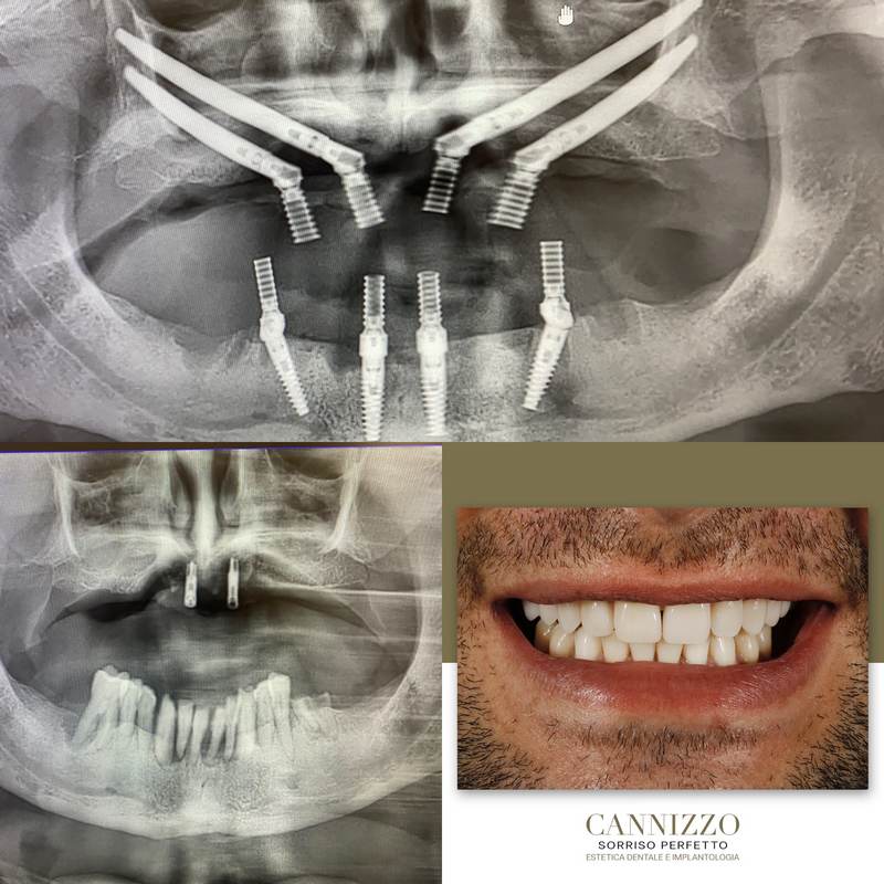 Sedazione nei trattamenti dentistici