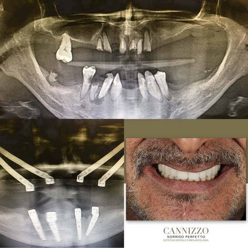 Sedazione nei trattamenti dentistici
