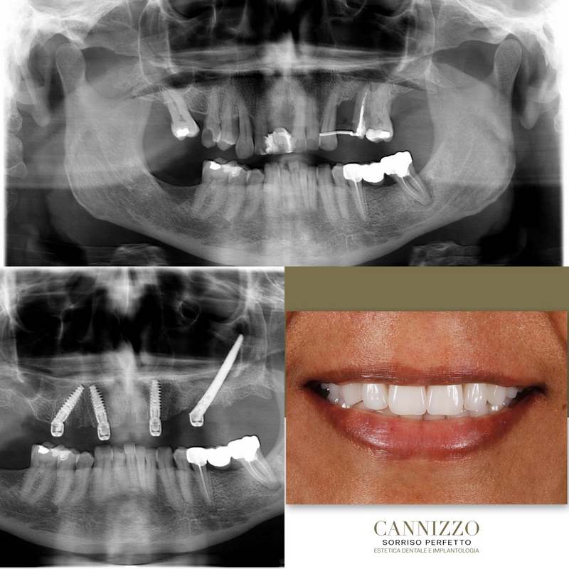 Sedazione nei trattamenti dentistici