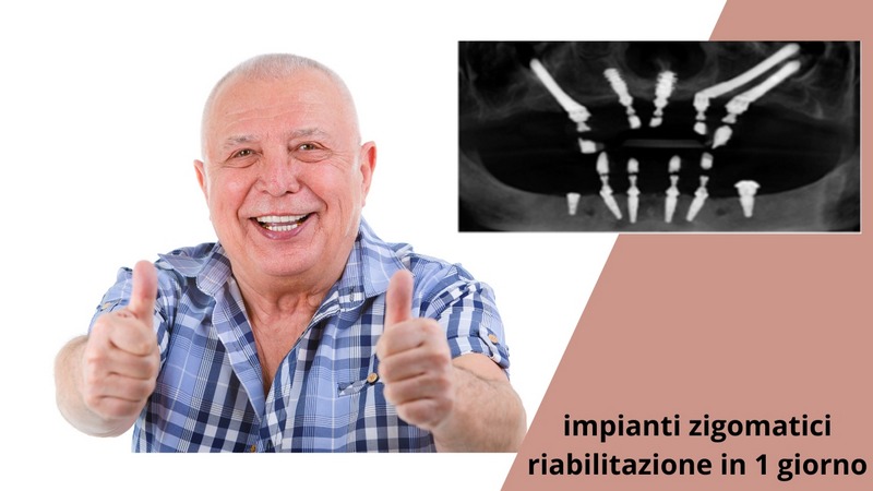 Impianti zigomatici