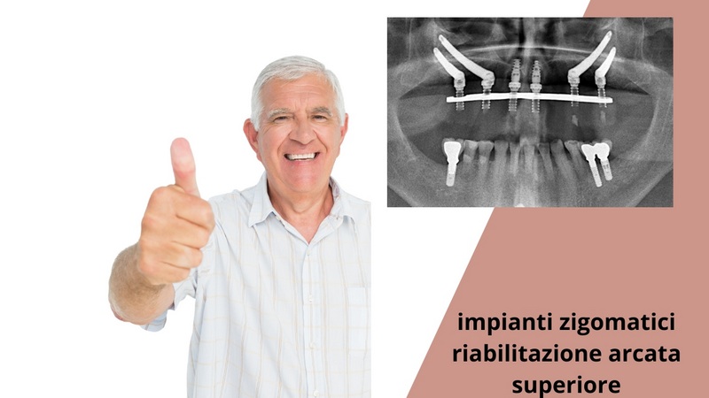 Impianti zigomatici