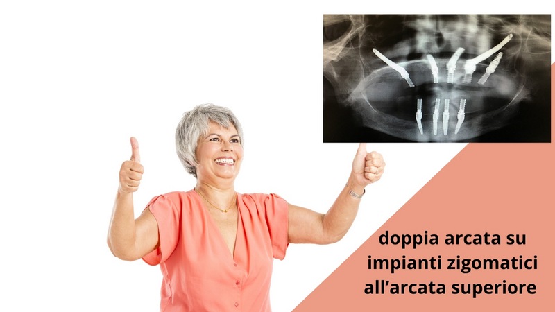 Impianti zigomatici