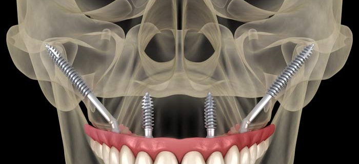 denti fissi con poco osso