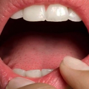 Patologie delle mucosi orali