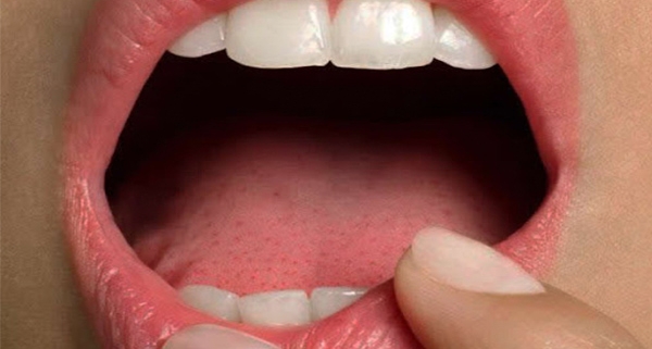 Patologie delle mucosi orali