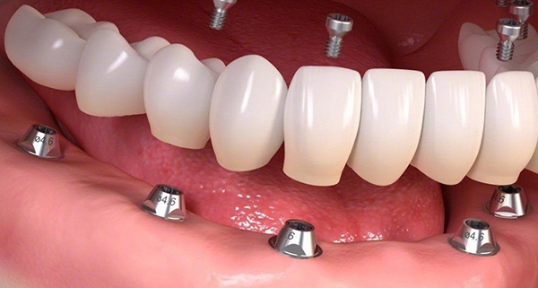 Rimuovere un impianto dentale