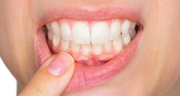 Impianti dentali in titanio e allergia al nichel
