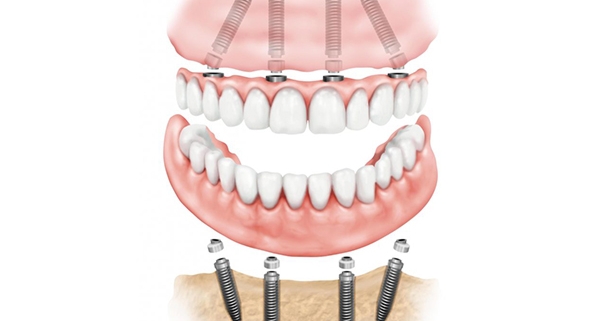 Impianti dentali senza osso: zigomatici e all on four