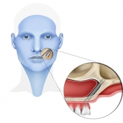 Vantaggi degli impianti zigomatici in pazienti con perdita ossea dentale